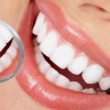 Что необходимо знать об отбеливании зубов